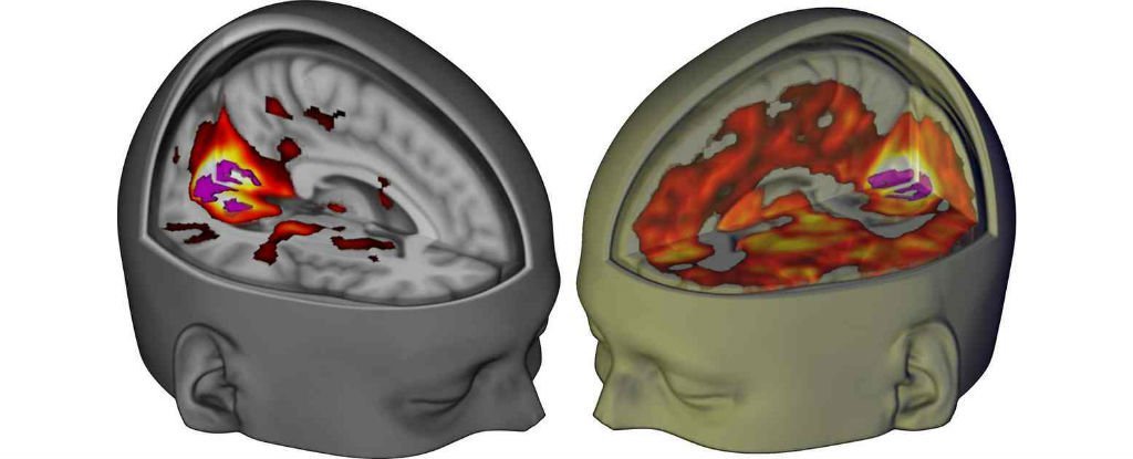 Сканы мозга показали, как ЛСД действует на сознание / Хабр