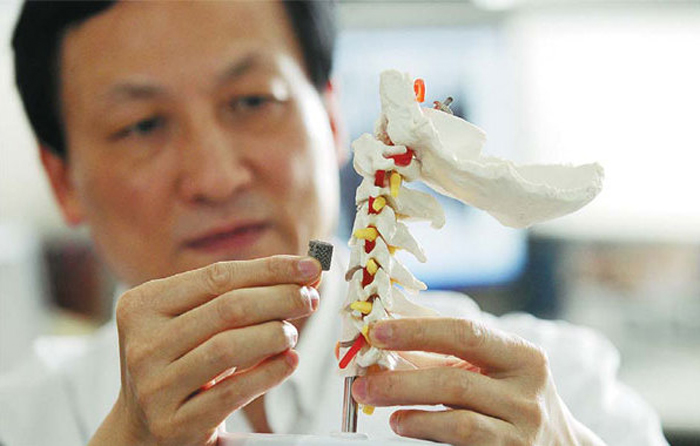 Liu Zhongiun, Director of Orthopedics at Peking University, holding the 3D printed vertebra.