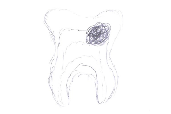 Двухмерный зуб — 1