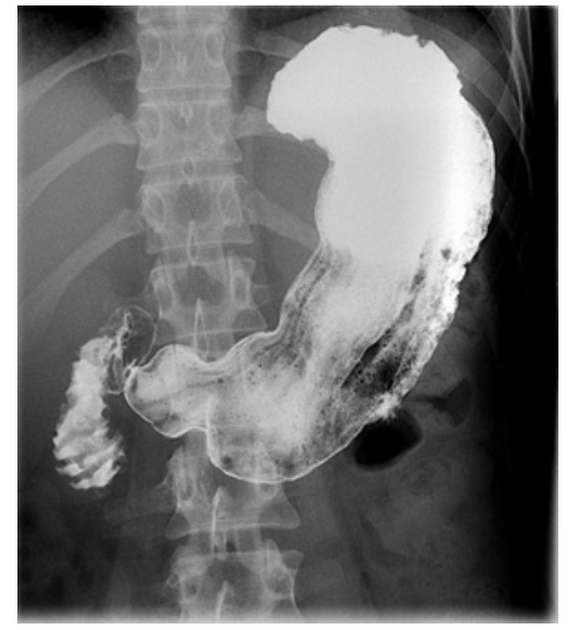 Рентген с контрастом. Рентгенологическое исследование желудка норма. Двойное контрастирование желудка рентген. Скопия желудка рентген. Контрастирование желудка рентген.
