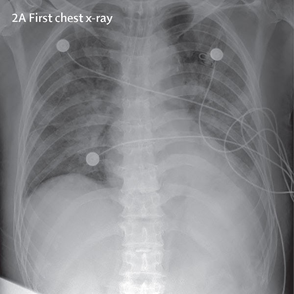 Как Выглядит Рентген Здоровых Легких Фото