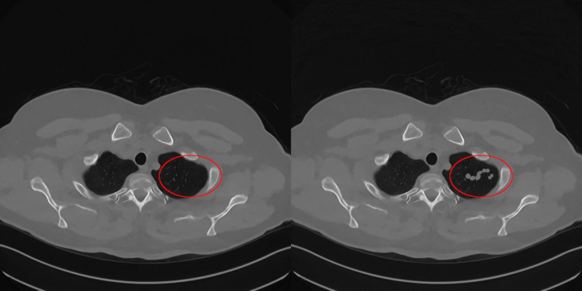Рис. 12. Изображения с реконструкцией здорового пациент алгоритмом LPDR без искажений (левое изображение) и с подобранным искажением (правое) на исходные данные
