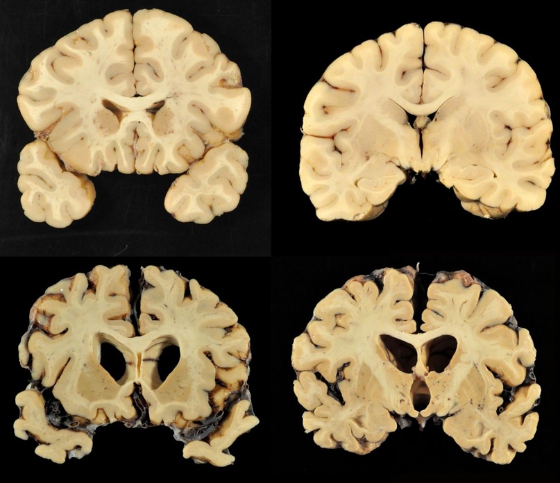 Срез здорового мозга (сверху), срез мозга с губчатой энцефалопатией (снизу)