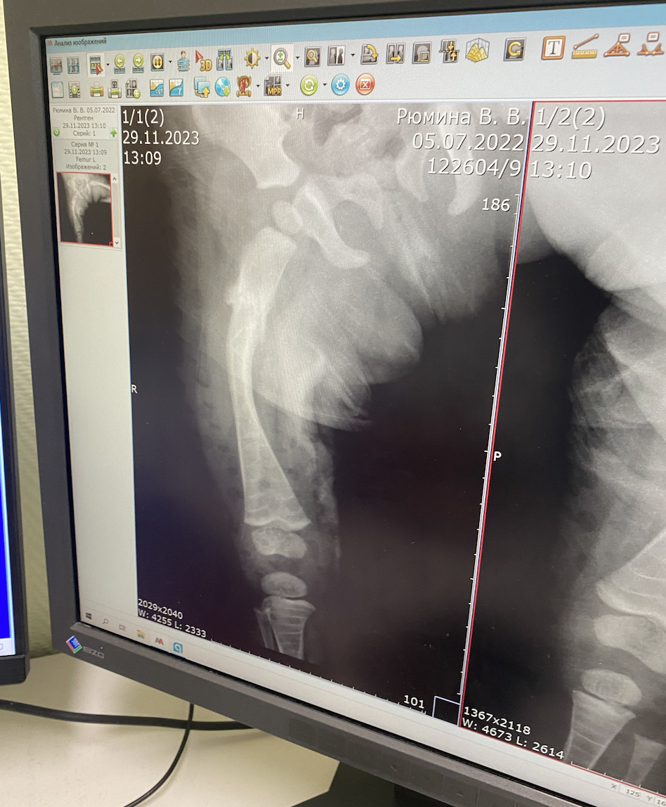 На рентгеновском снимке видны кольца, как на дереве, – это полосы отложения кальция на костях. Рентген Веры Рюминой, 6 курсов бисфосфонатов.