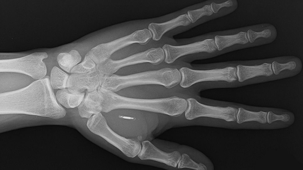 Фото BBC: Рентгеновский снимок импланта