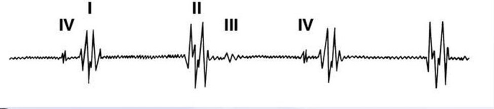 Рисунок 6 - Фонокардиограмма с отображением тонов