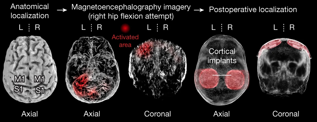 Здесь видны данные МРТ. Красным обозначены кортикальные поля, ответственные за движение. Справа можно увидеть две круглые структуры. Так выглядят кортикальные имплантаты, «сидящие» на головном мозге.