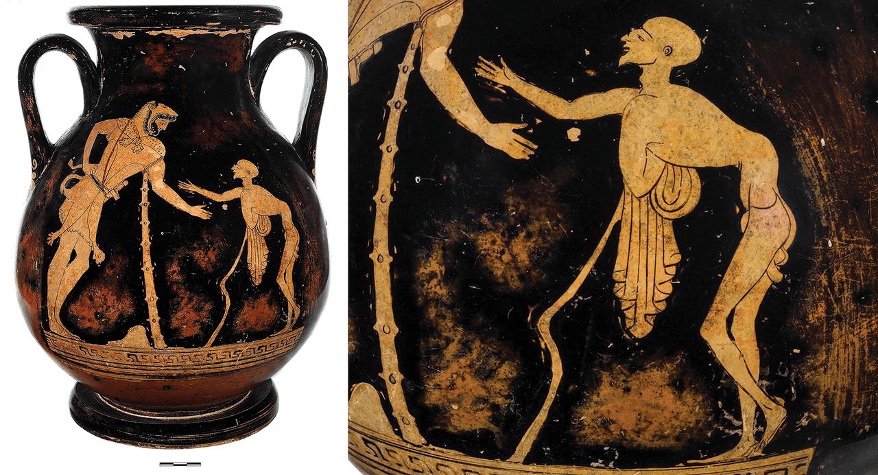 Греческая амфора 5 века до н.э.
Слева Геракл.
Справа — бог старости Герас на рисунке запечатлен с деформированным позвоночником и атрофированными мышцами — характерными признаками полиомиелита.