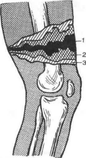В качестве примера изображение строения огнестрельной раны бедра: 1. Зона раневого канала 2. Зона ушиба (первичного травматического некроза) 3. Зона молекулярного сотрясения (вторичного некроза)