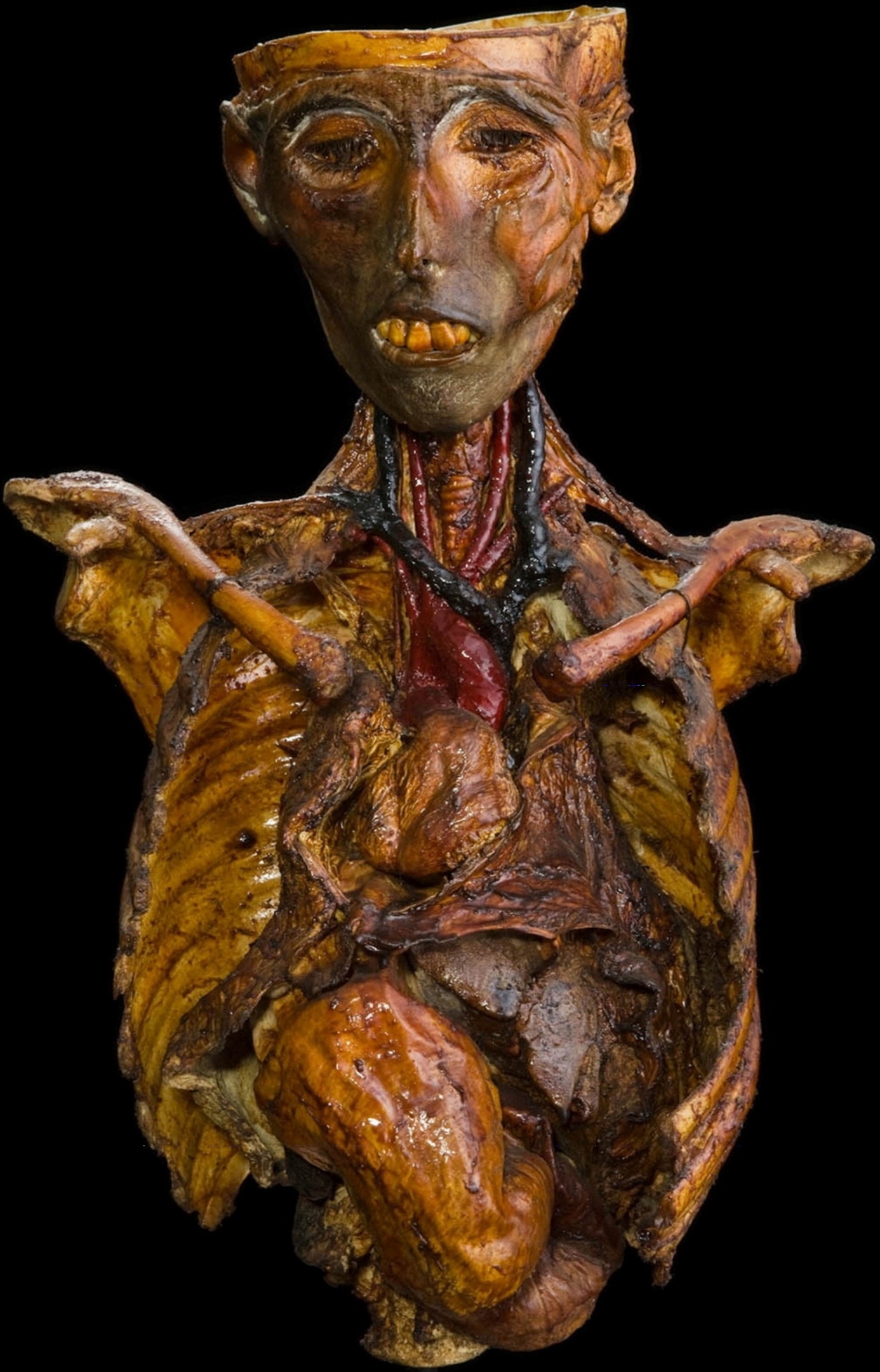 Анатомический препарат мумии с situs inversus totalis и декстрокардией, сохраненной с помощью техники дубления. Хранится в Музее патологической анатомии Падуанского университета.