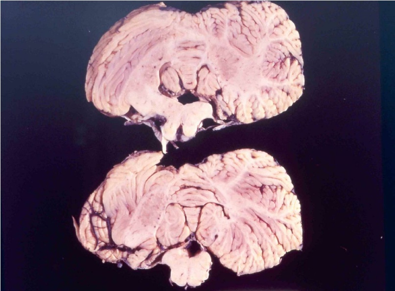 Мозг пациента погибшего от куру