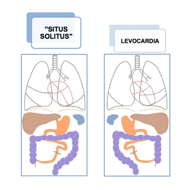 Правильное расположение органов (слева). Левокардия (справа).