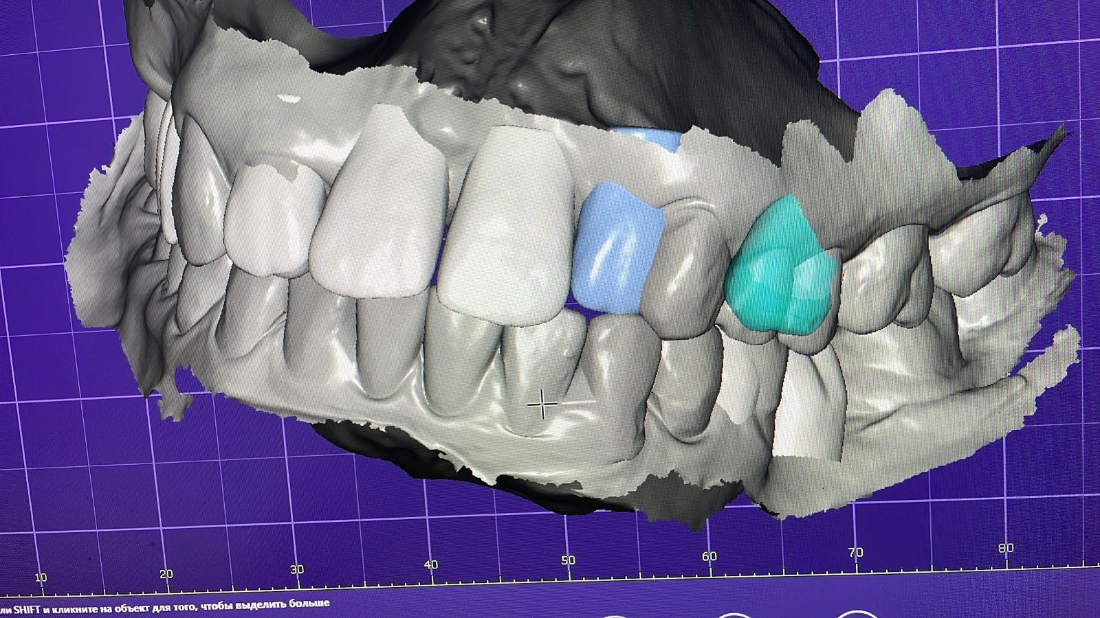 «Примерка» будущих реставраций на сетапе ортодонтического лечения в программе Exocad
