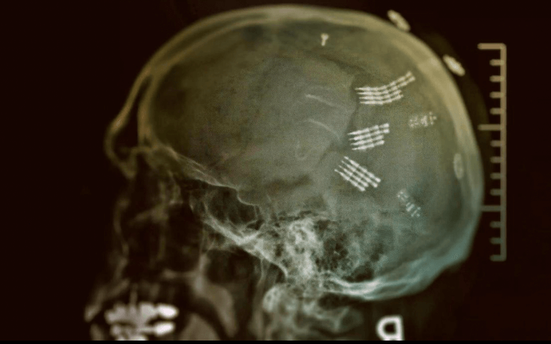 КТ электродов, имплантированных в мозг доктора Фила Кеннеди в 2014 году