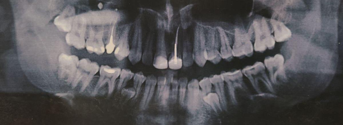 Мои зубы в 16 лет. На фото видно уже почти почти сформировавшиеся сверхкомплектные четверки и уже кривые зубы снизу
