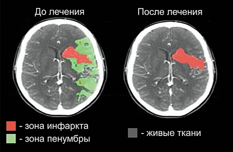 Пример лечения зоны пенумбры у пациента с ишемическим инсультом (источник: Институт нейрохирургии им. Н.Н. Бурденко).  