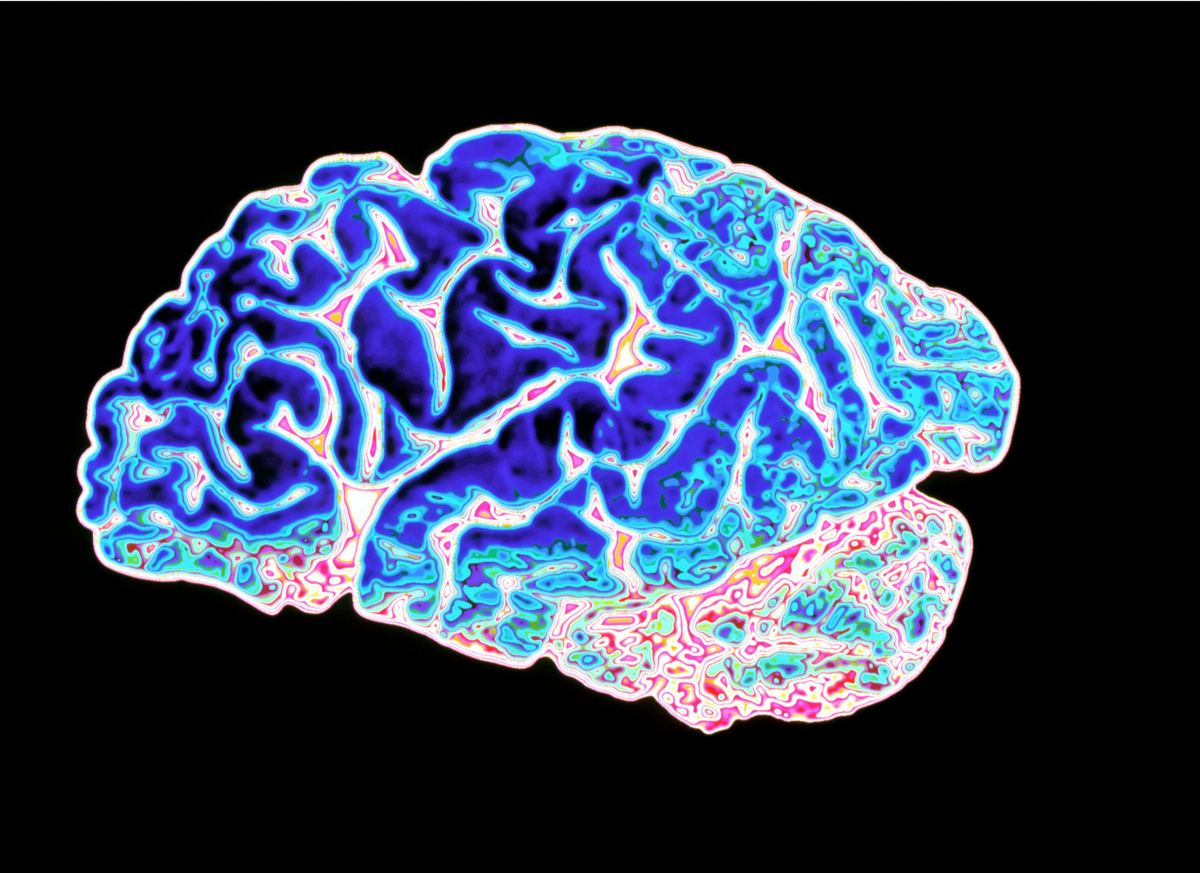 Ученые разобрались, как развивается болезнь Альцгеймера