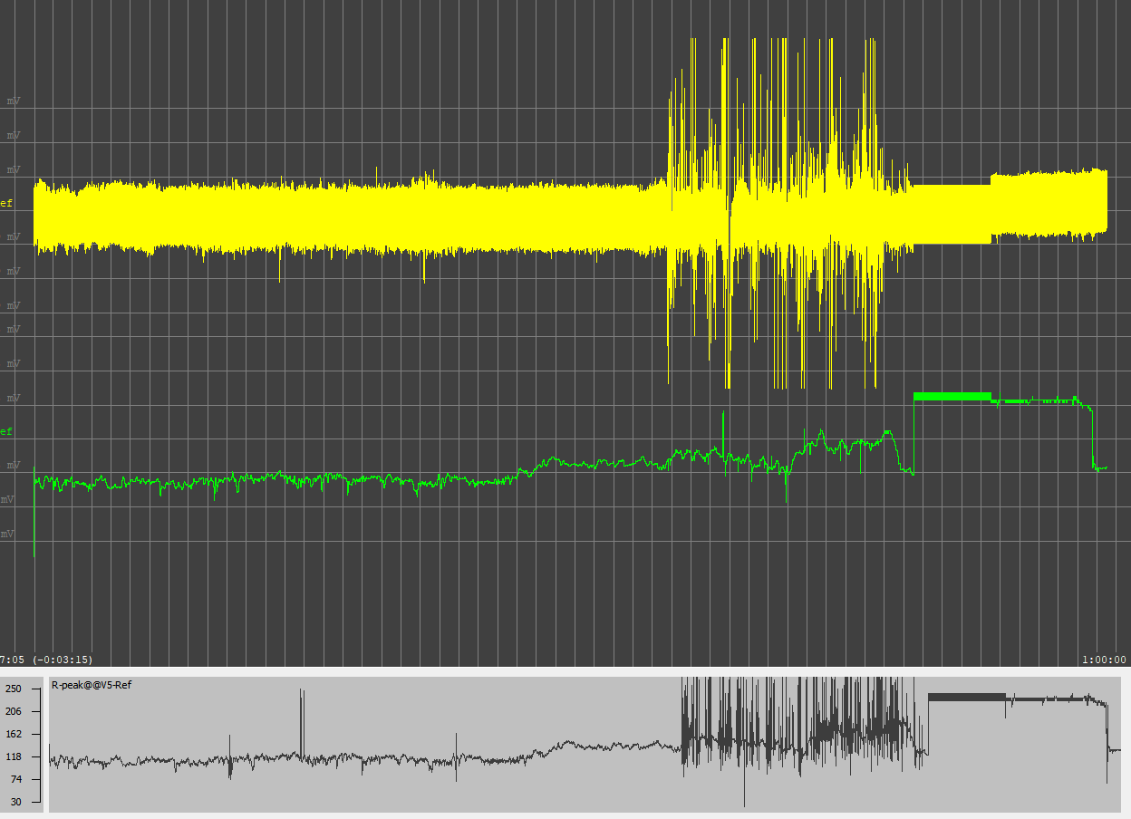 Рис.1.  представлены графики:  желтый- сигнал ЭКГ, зеленый- сигнал алгоритма nkQRS, черный- сигнал алгоритма детектора QRS  EDFbrowser.