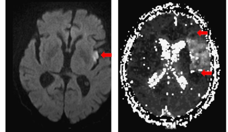 Слева на МРТ с диффузионно- взвешенным изображением (DVI) виден небольшой инсульт (стрелка).  Справа — МРТ с перфузией (PWI) показывает, что инсульт охватывает большую область пенумбры (между стрелками). Источник: ResearchGate  