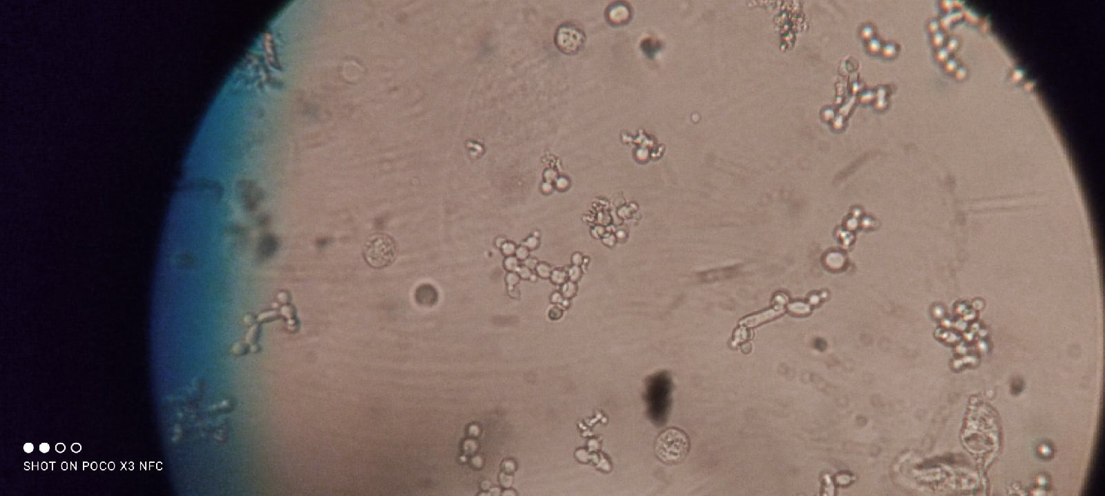 Дрожжеподобные грибы рода Candida в моче (урине) человека. Каждая клетка представляет собой отдельный организм.