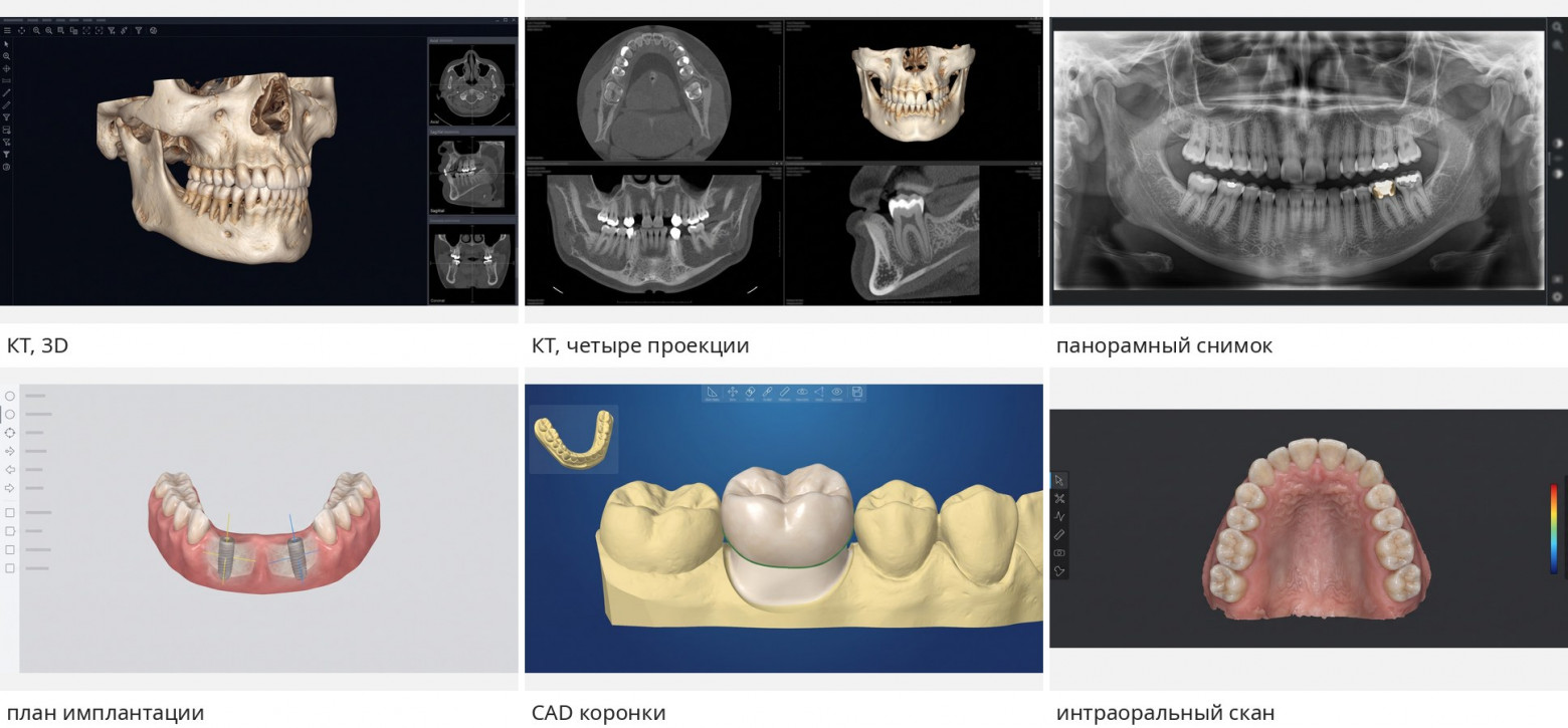 6 видов экранов: КТ в 3D и в проекциях, панорама, план имплантации, CAD коронки, интраоральный скан.