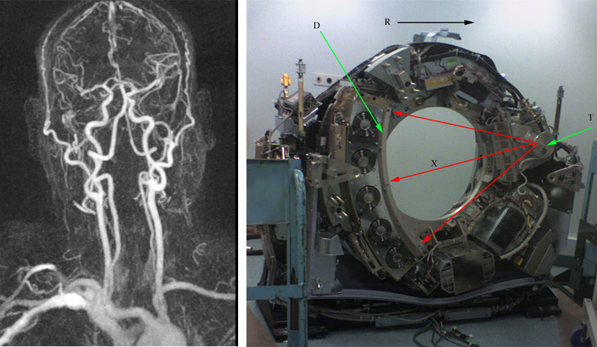 Слева: КТ-ангиография с контрастом – вводимое в кровь специальное соединение, нетоксичное для человека (до 30 смертей на миллион процедур), позволяющее усилить яркость сосудов на снимке. Такое исследование может выявить аномалии строения сосудов, например, аневризмы, либо ишемизированный или деваскуляризованный участок мозга. Справа: устройство детектора прибора КТ. Рентгеновские лучи идут от излучателя (Т) в направлении красных стрелок. Под стрелкой D расположен блок детекторов.