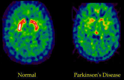 PET-изображение трейсера фтор-ДОФА в нормальном мозгу и у больного болезнью Паркинсона. Во втором случае отсутствует красный сигнал от накопления предшественника дофамина в нигростриатной системе мозга, что говорит о серьезной степени нейродегенерации.