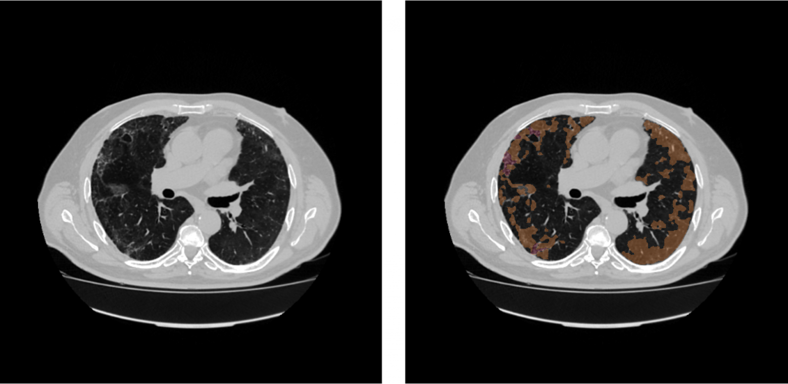 КТ-снимок пациента, больного COVID-19, цветом отмечена патология “матовое стекло”. Источник - Botkin.AI