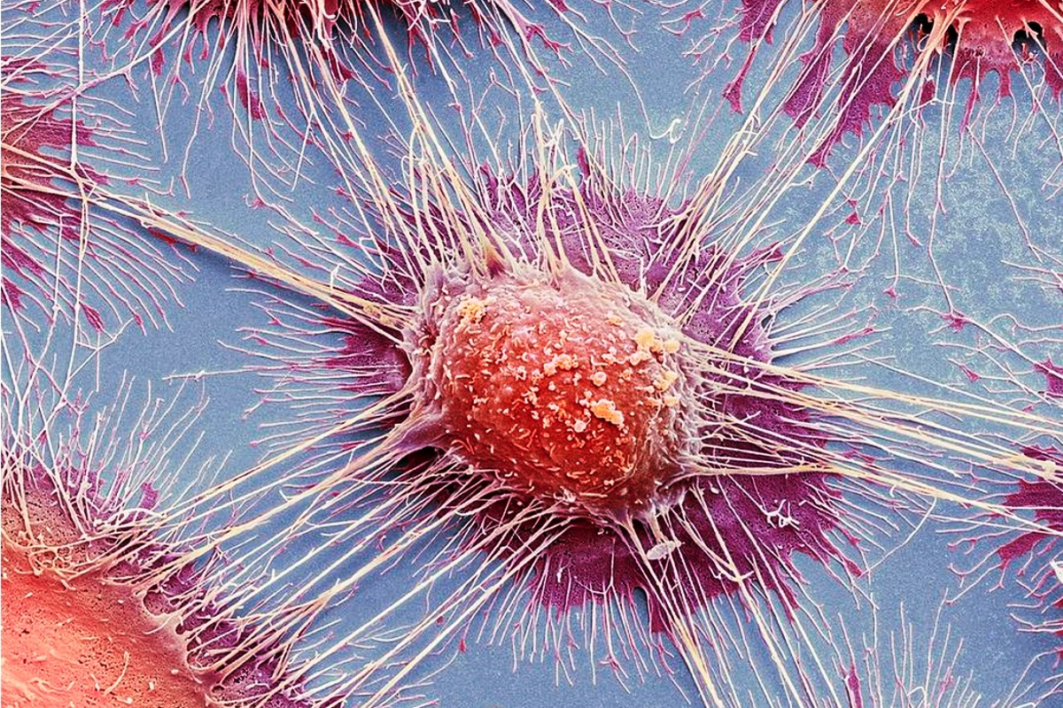 Раковая клетка под микроскопом.