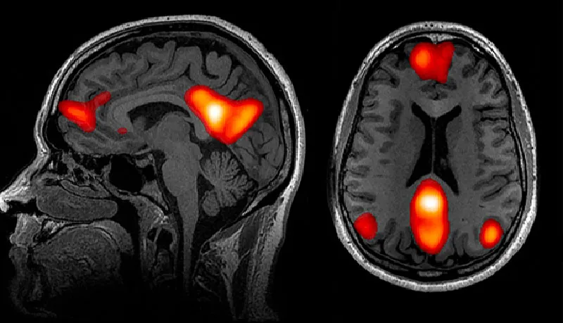 Томограммы человеческого мозга в сагиттальной и аксиальной проекции, где показаны более светлые области активности префронтальной коры, угловой извилины и поясной коры