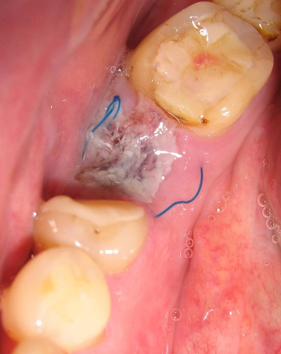 Альвеолит после удаления зуба — причины, симптомы и лечение
