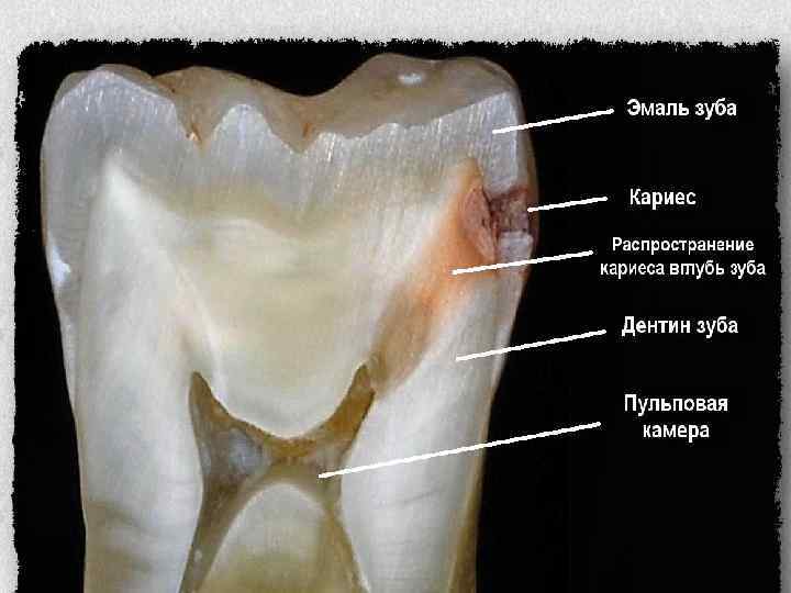 Зубная эмаль - это самая твердая ткань во всем организме, она даже крепче чем кости. Именно поэтому, когда кариес достигает дентина, то процесс начинает расти вширь. 