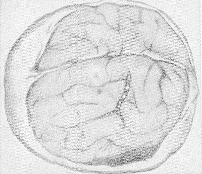 Головной мозг собаки с аэроэмболией сосудов (газовые пузырьки — светлые пятна на темном фоне сосуда) после декомпрессии.