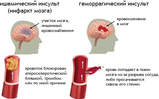 Статины. Что? Зачем? Подводные., изображение №7