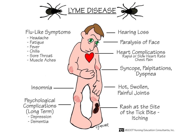 Симптомы болезни Лайма