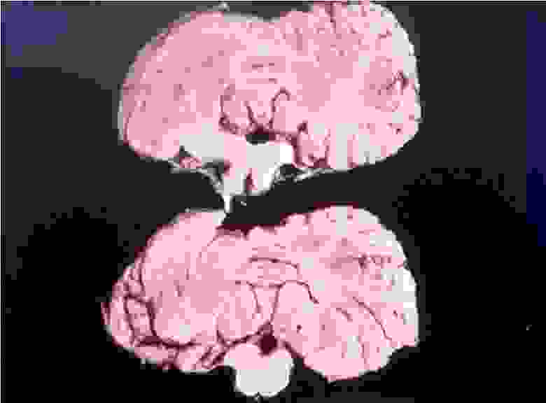 Мозг пациента погибшего от куру
