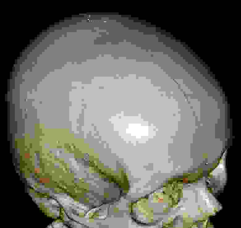 Измерение длины черепа на КТ изображении