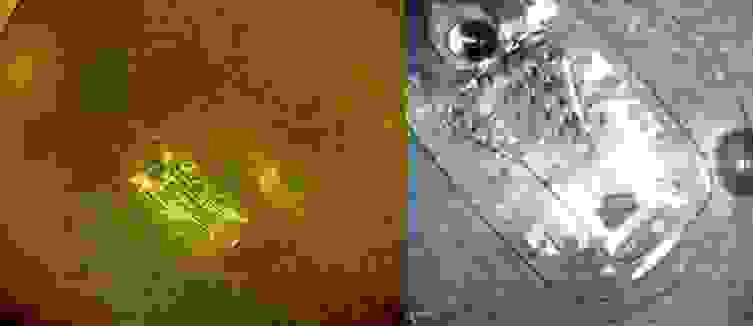 Фото (слева) и увеличенное КТ-изображение (справа) ретинального импланта Argus на сетчатке глаза