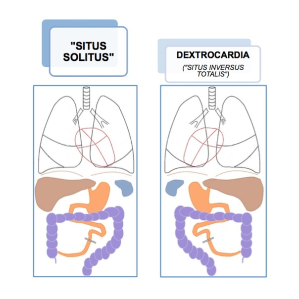 Правильное расположение органов (слева). Декстрокардия (справа).