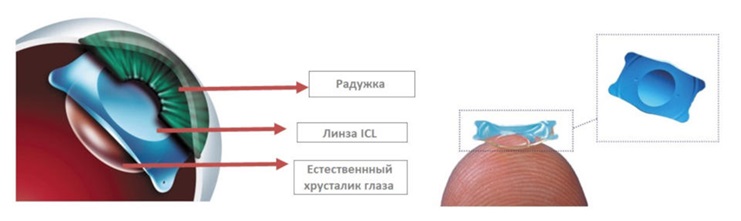 Имплантация факичных заднекамерных контактных линз ICL
