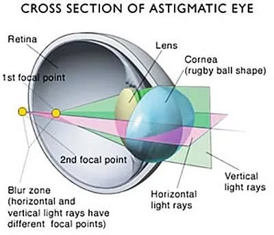 Причины плохого зрения при астигматизме