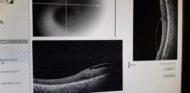 Оптическая когерентная томография при эпиретинальной мембране