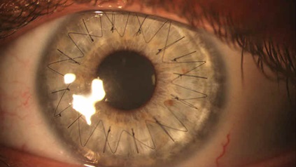 Пересаженная роговица глаза (после кератопластики)