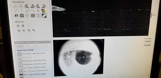 Оптическая когерентная томография переднего отрезка глаза