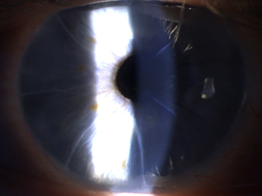 Радиальная кератотомия - насечки на роговице глаза