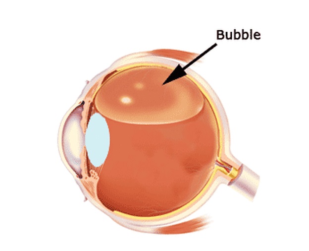 Введение газов в глаз при лечении отслойки сетчатки