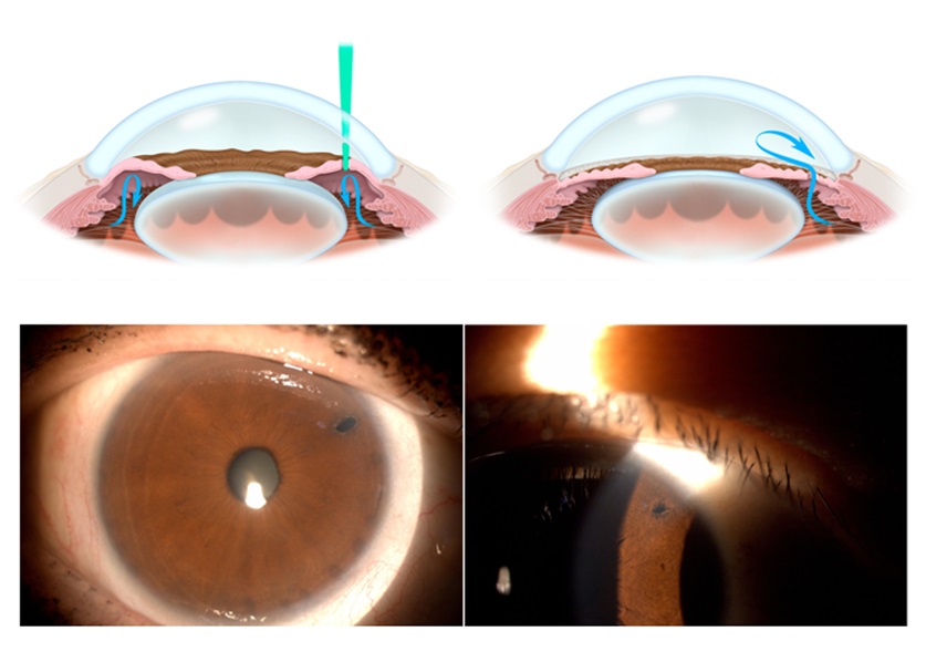 laser iridectomy - LIE for glaucoma