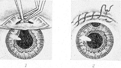 Iridectomy - a method of surgical treatment of glaucoma