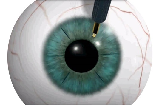 Операции на глазах по улучшению зрения