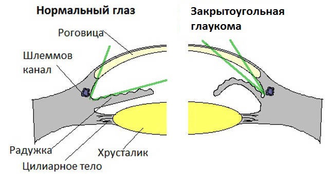 laser methods for glaucoma